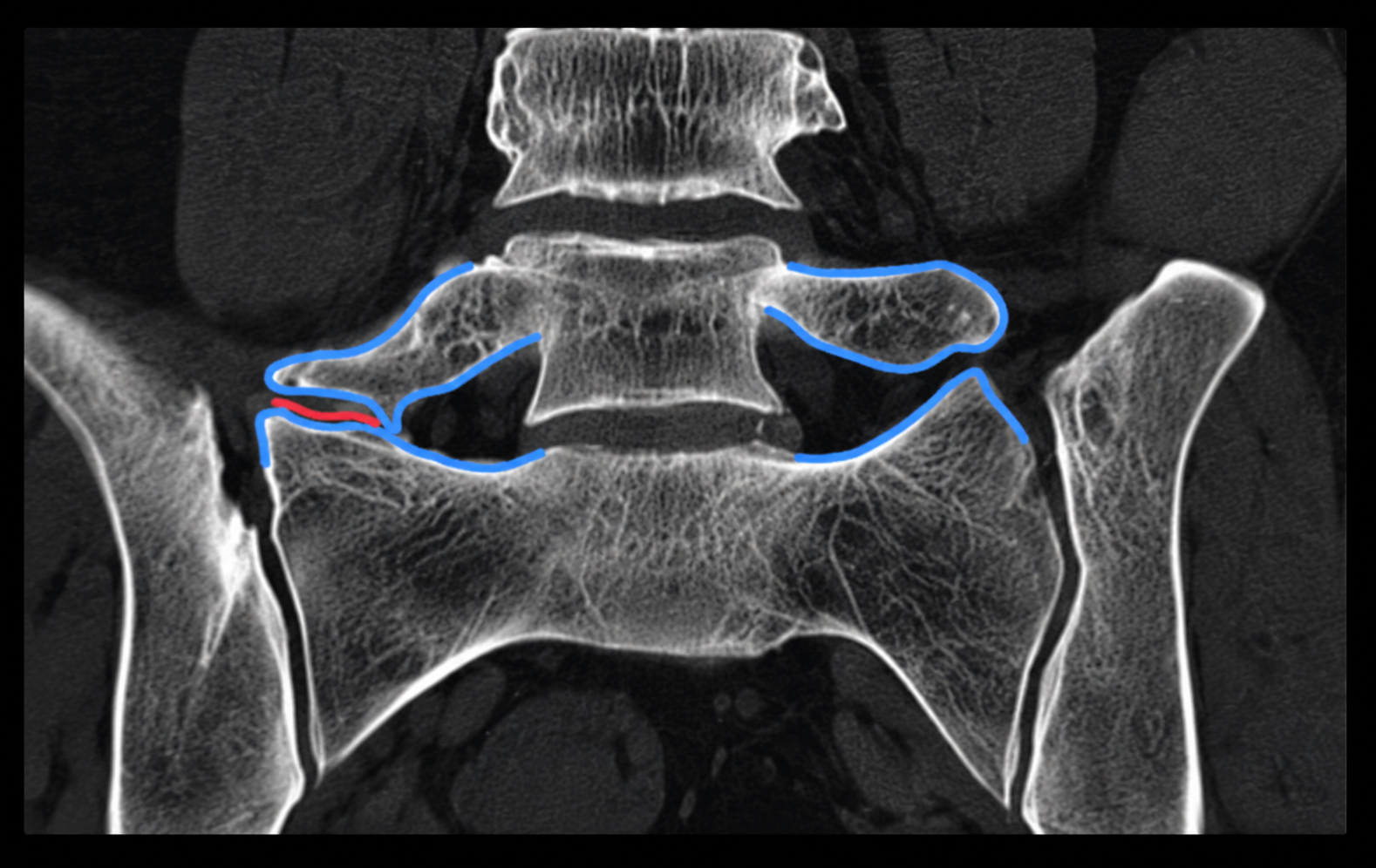Bertolotti's Syndrome — anatomical illustration