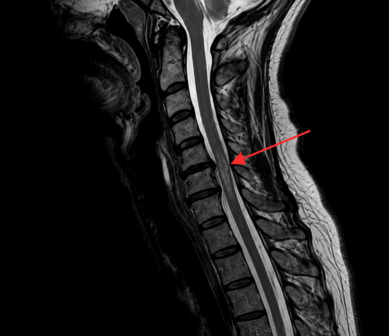 Cervical Myelopathy — anatomical illustration