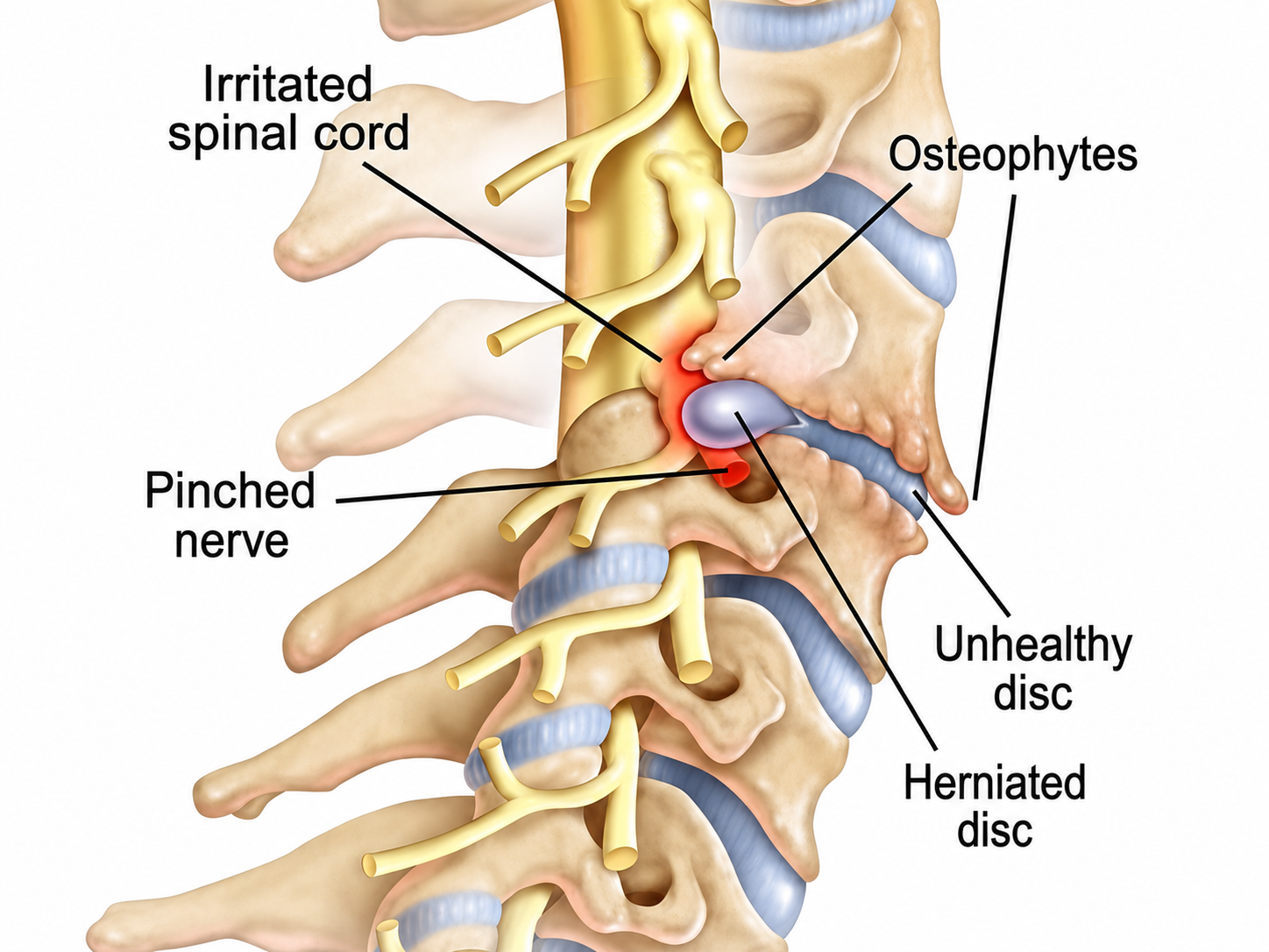 Cervical Radiculopathy — anatomical illustration