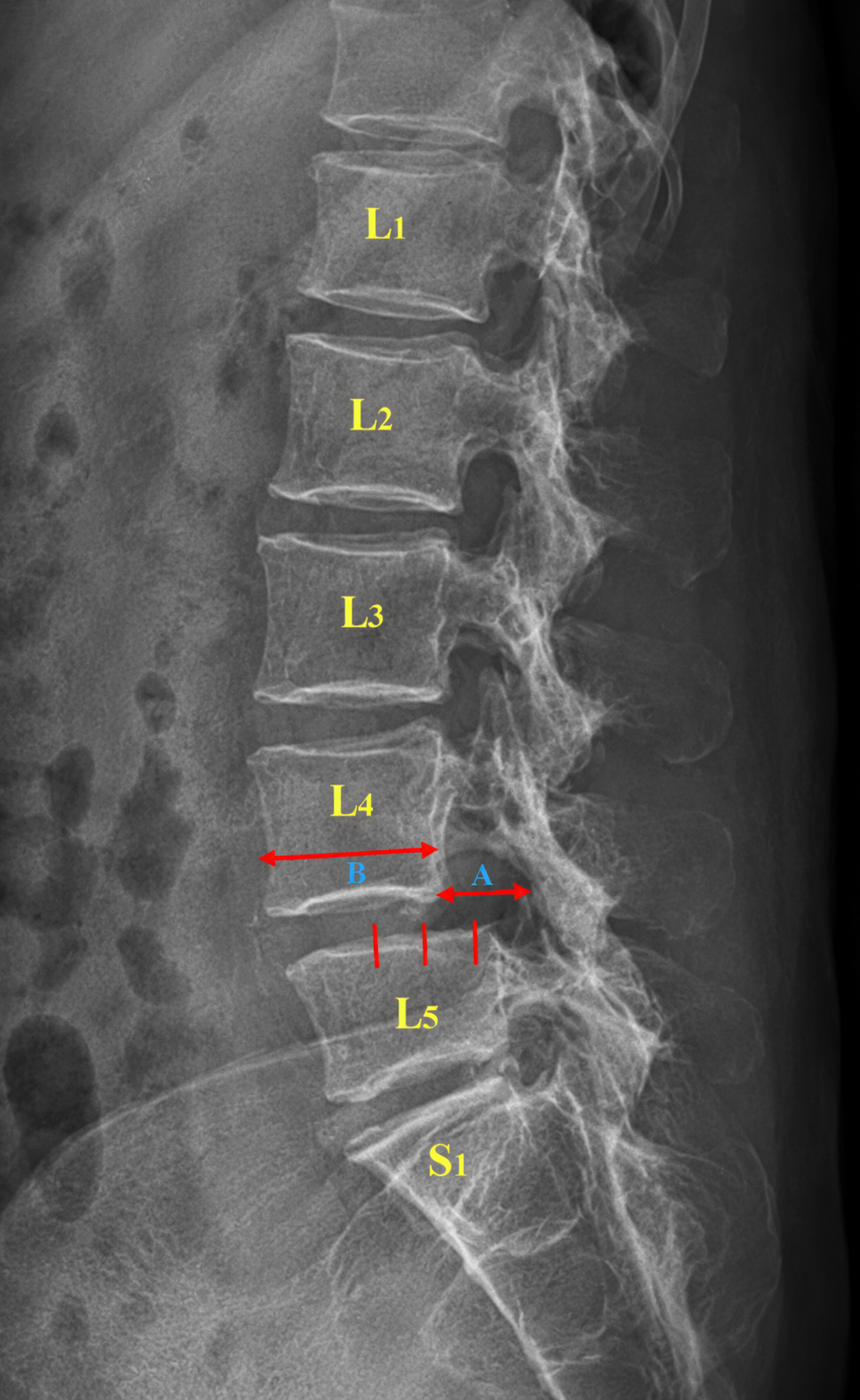 Spondylolisthesis — anatomical illustration