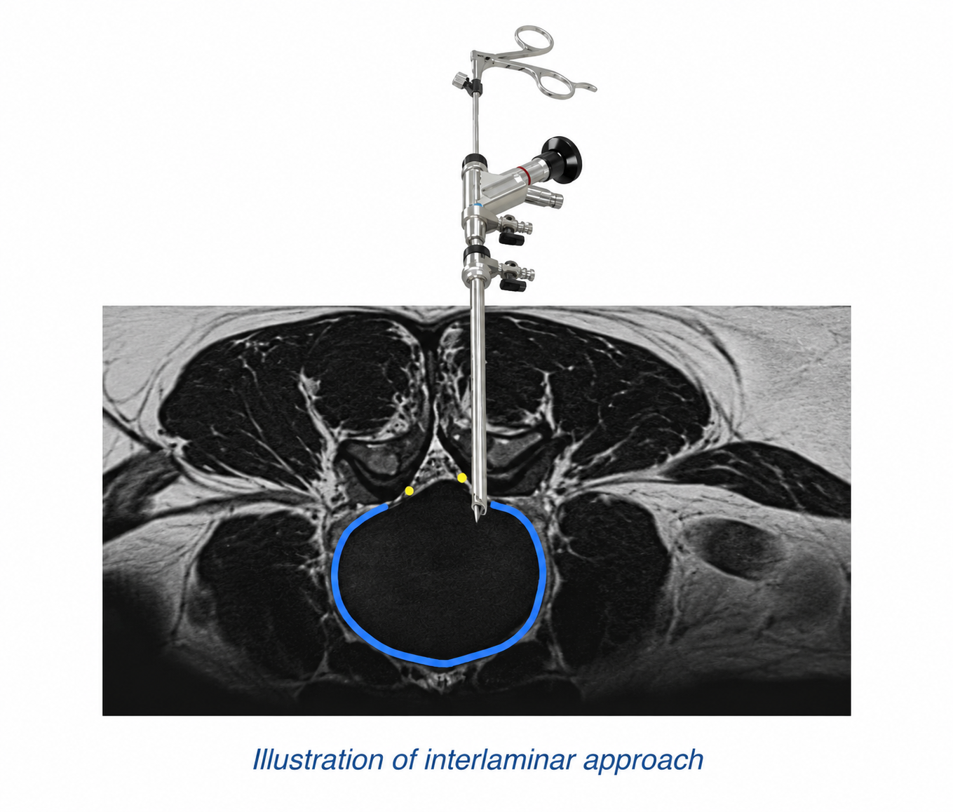 Illustration of the interlaminar approach used in endoscopic spinal surgery