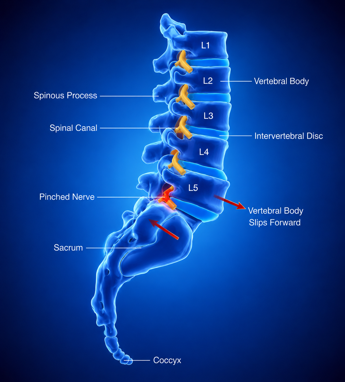 Spinal Instability — illustration