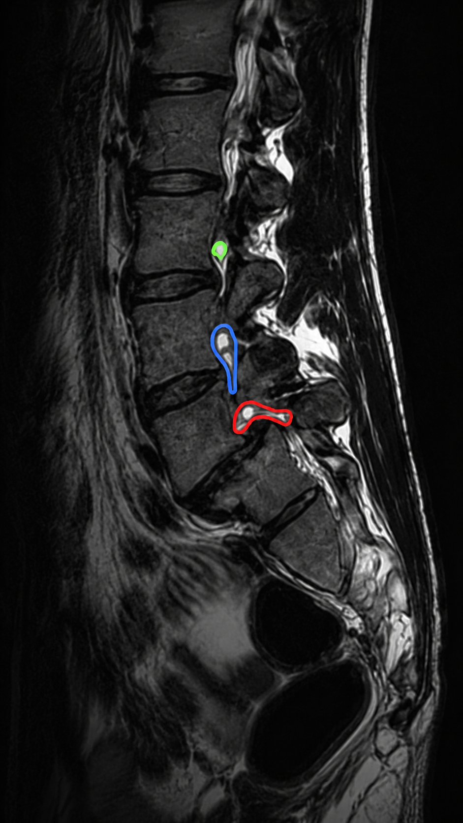 Sequential MRI scan of the lumbar spine showing nerves (green) moving from the central canal toward the outer lanes and then exiting via the foramina.