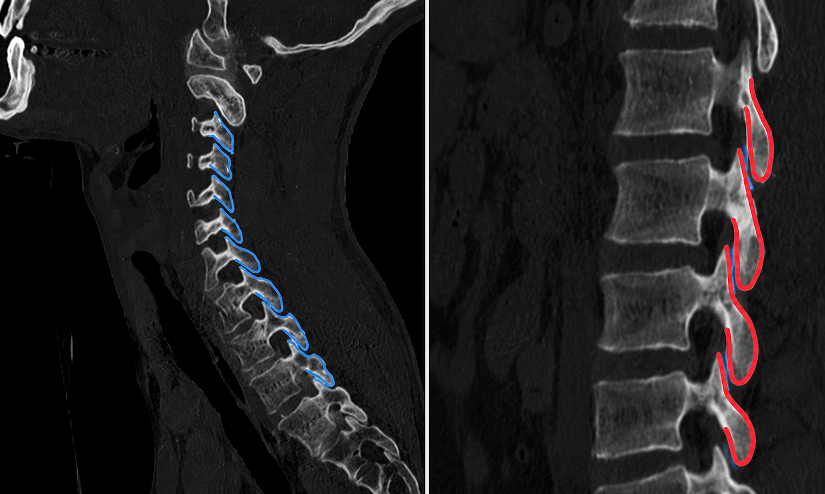CT scan comparison, side by side. The cervical facet joint (blue) shows the roof-tile arrangement; the lumbar facet joint (red) is lined with cartilage (blue) which lubricates the joint during movement.