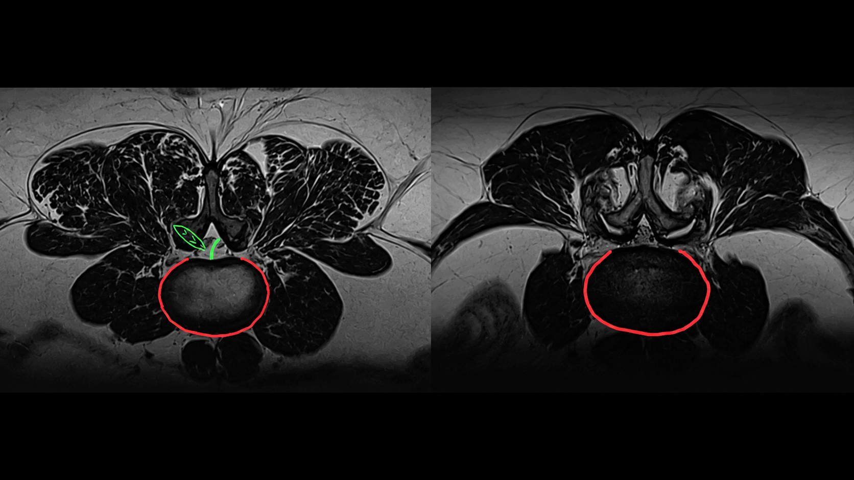 Axial MRI scans of the lumbar spine, side by side. The normal hydrated disc on the left has an apple-and-leaf shape; the dehydrated disc on the right has lost the apple stalk and appears bulging.
