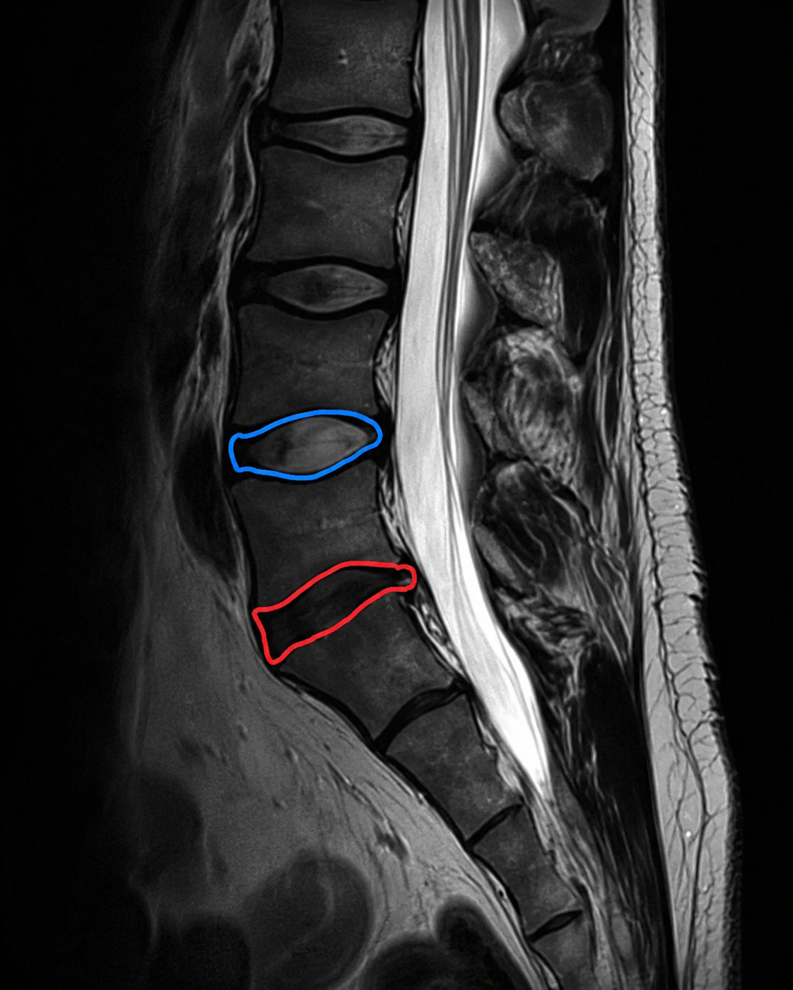 Sagittal MRI scan of the lumbar spine comparing a healthy hydrated disc (blue outline, brighter appearance) with a dehydrated disc below (red outline, darker and flatter).