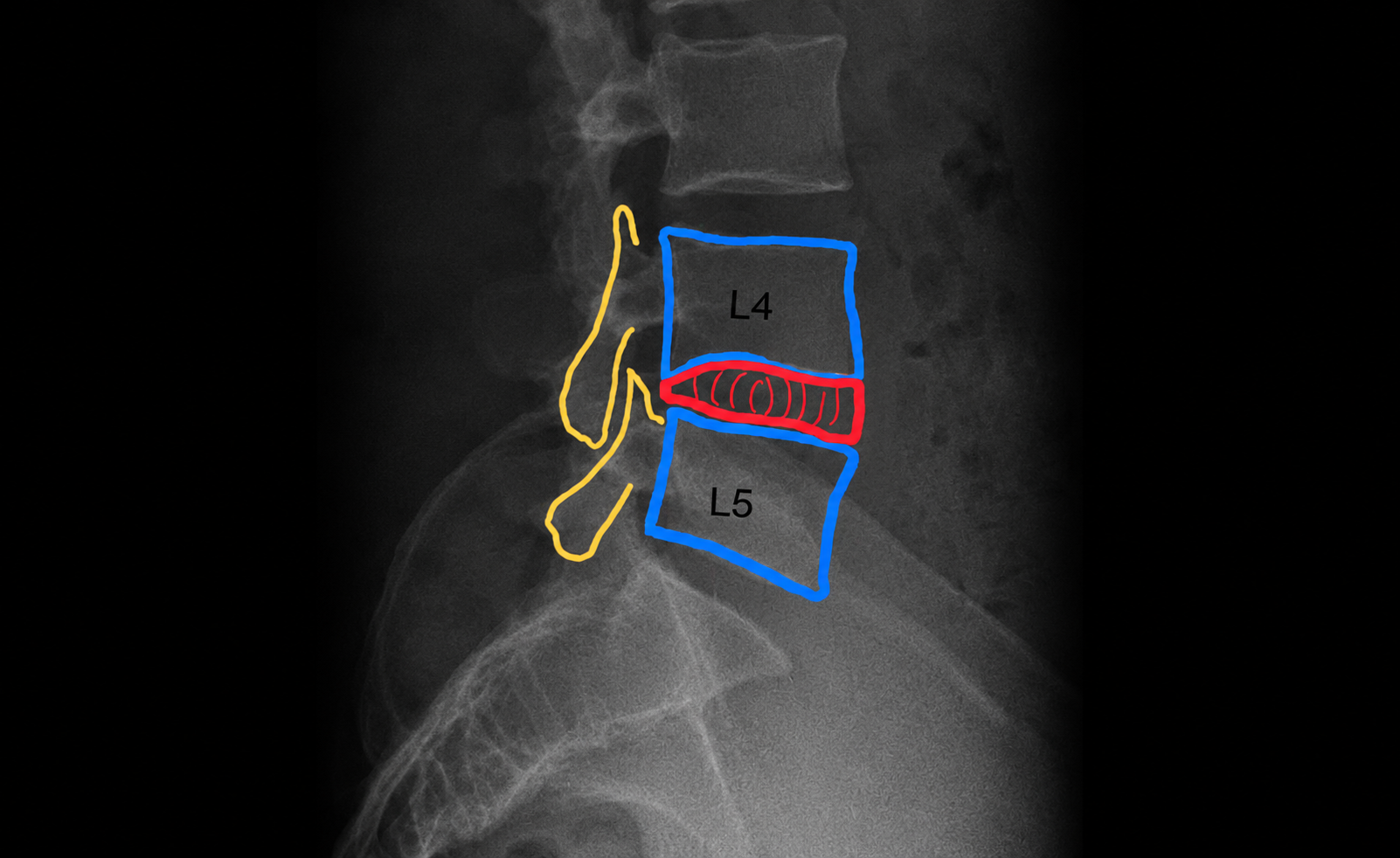 X-ray of the lumbar spine showing the disc (outlined in red) sandwiched between two vertebrae, with the facet joints (outlined in yellow) arranged like roof tiles.