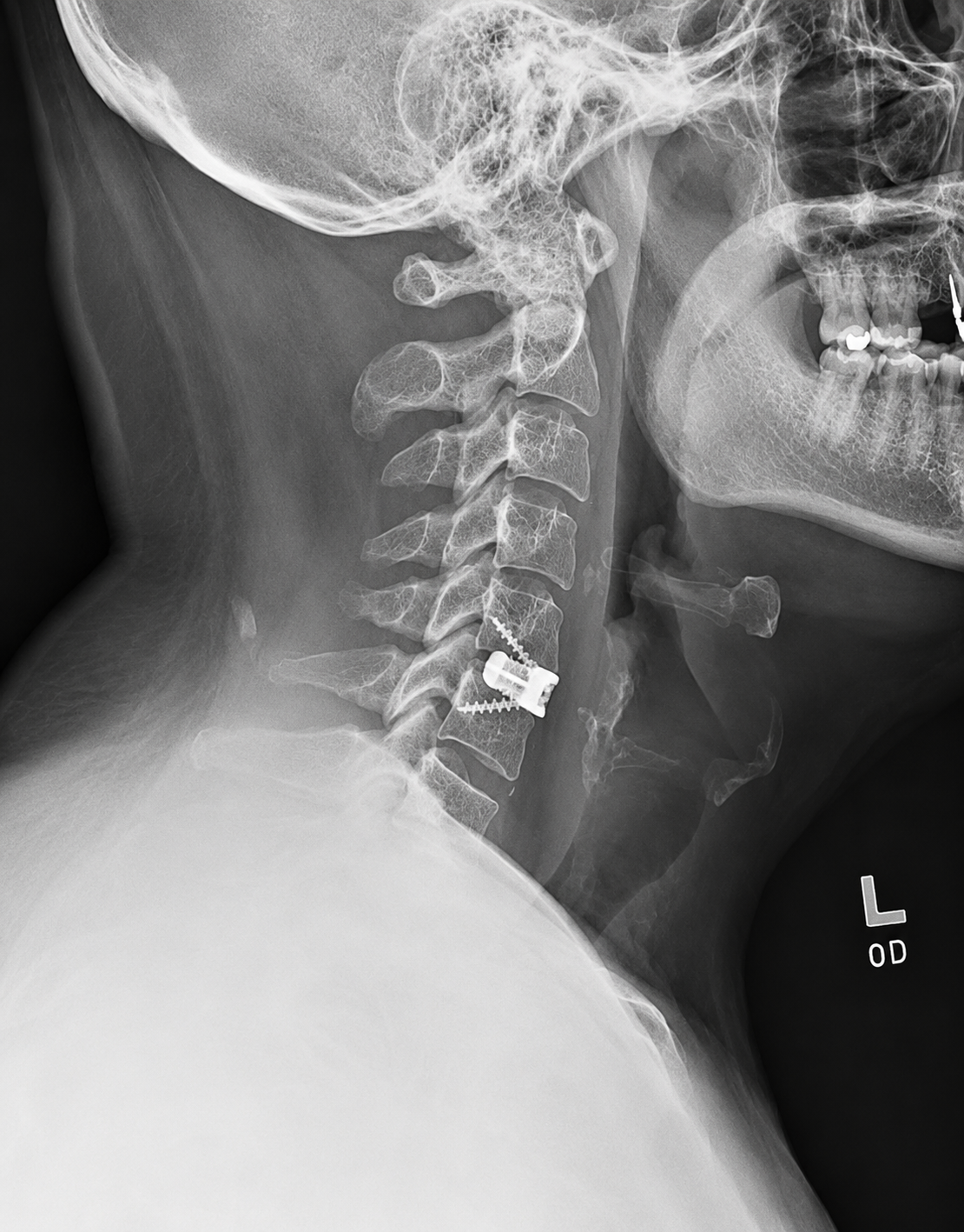 Anterior Cervical Discectomy and Fusion (ACDF) — treatment