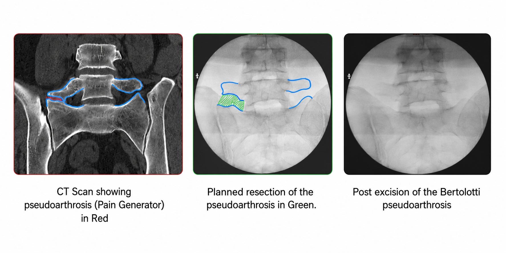 Endoscopic Treatment for Bertolotti's Syndrome — keyhole procedure