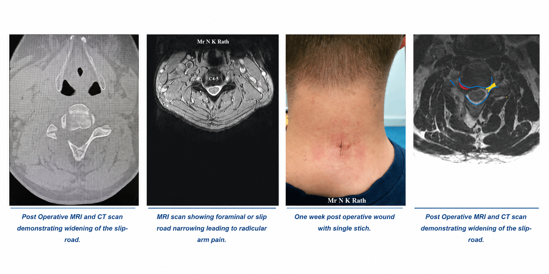 Endoscopic Cervical Foraminotomy — keyhole procedure