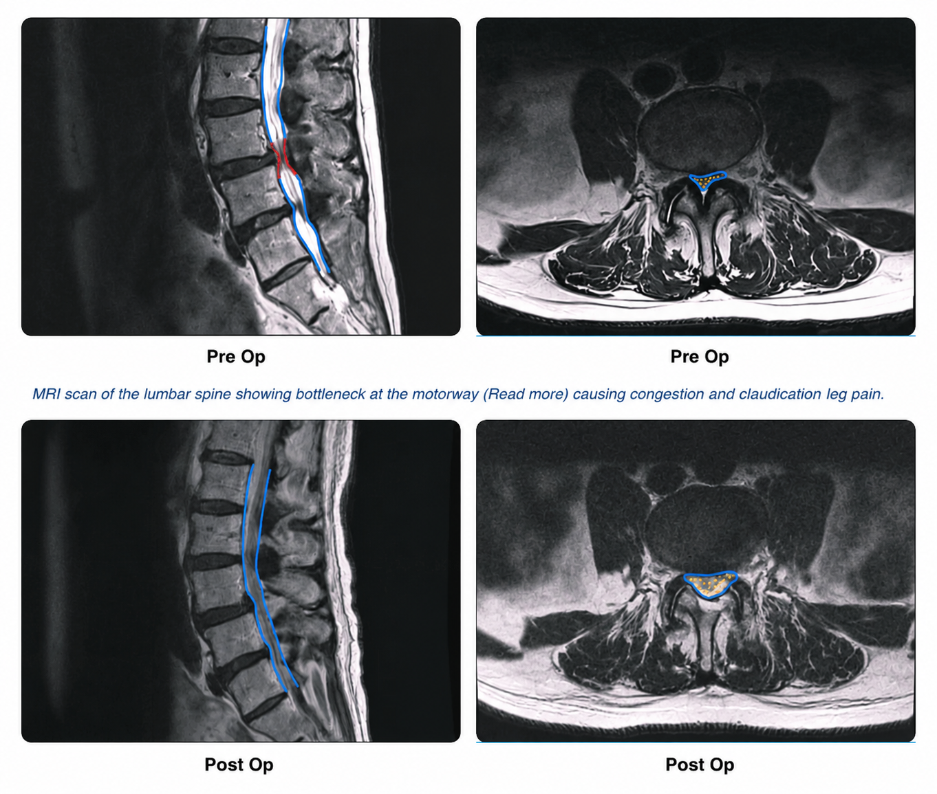Endoscopic Lumbar Decompression — keyhole procedure