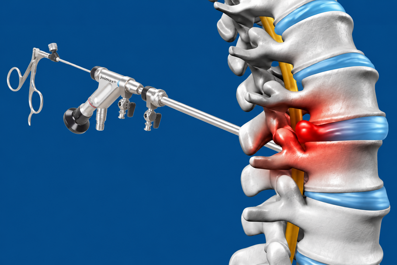 Endoscopic Lumbar Discectomy — keyhole procedure