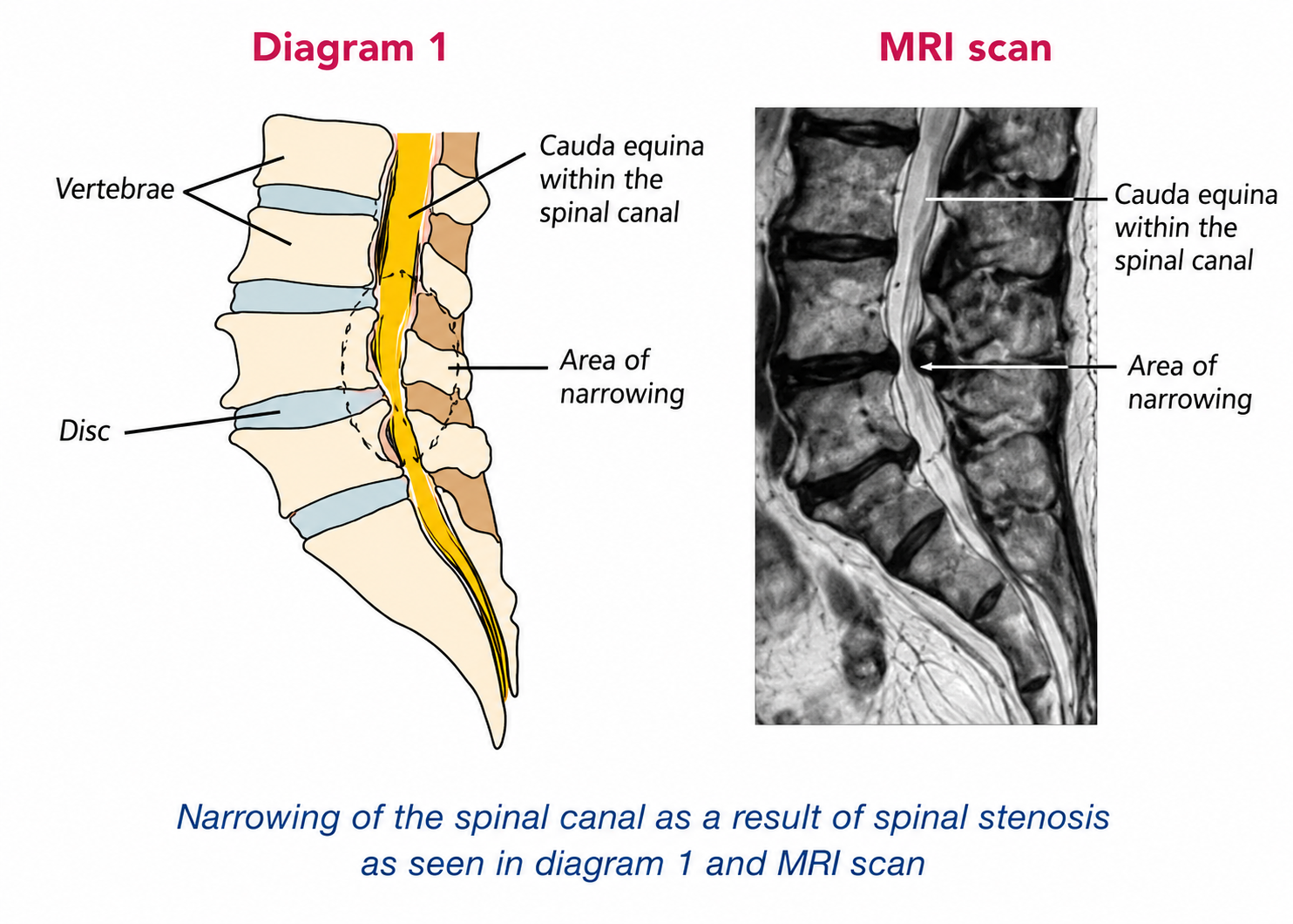 Lumbar Decompression — treatment