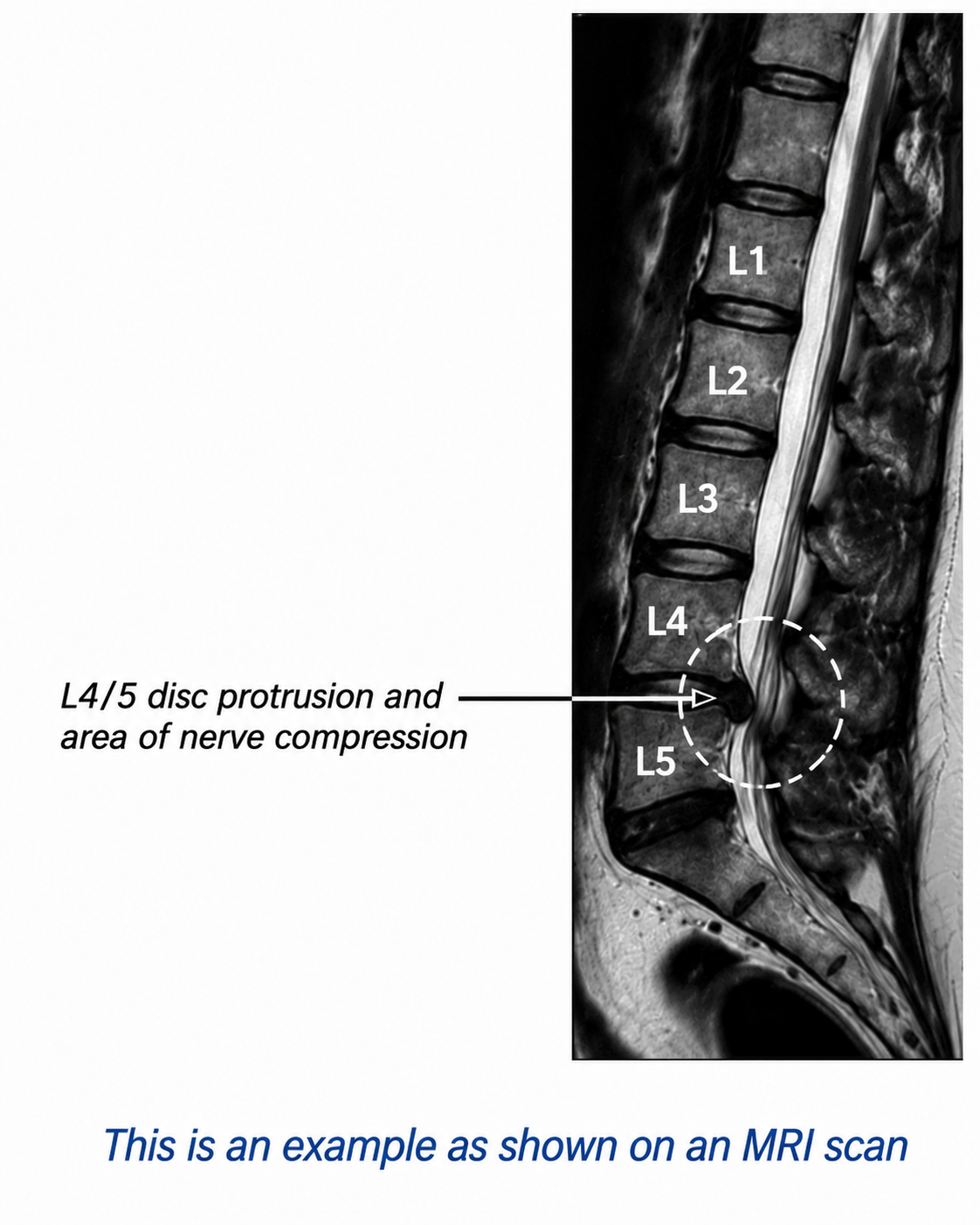 Lumbar Discectomy (Open / Microdiscectomy) — treatment