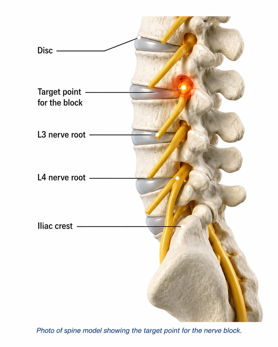 Nerve Root Block — treatment
