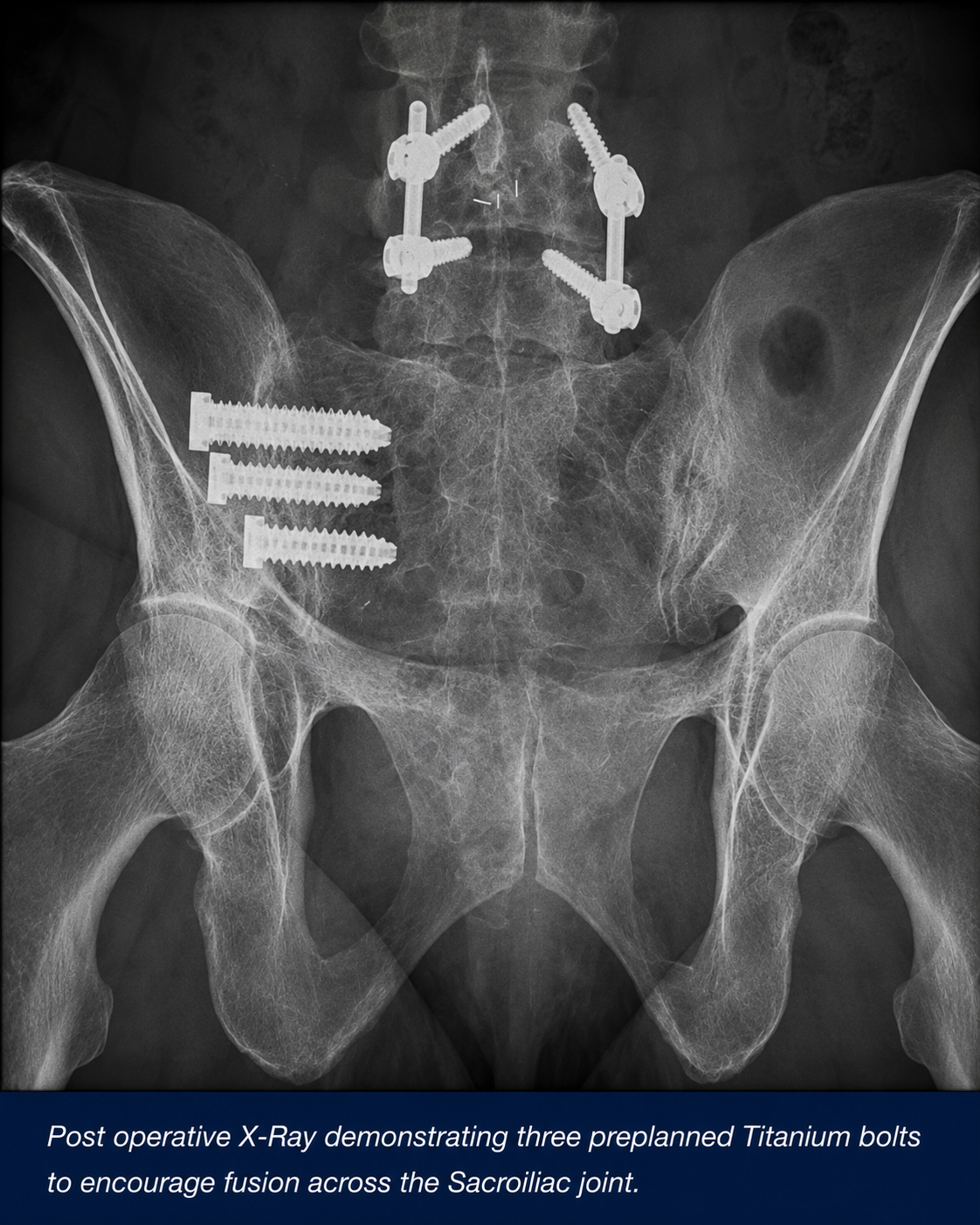 Sacroiliac Joint Surgery — treatment